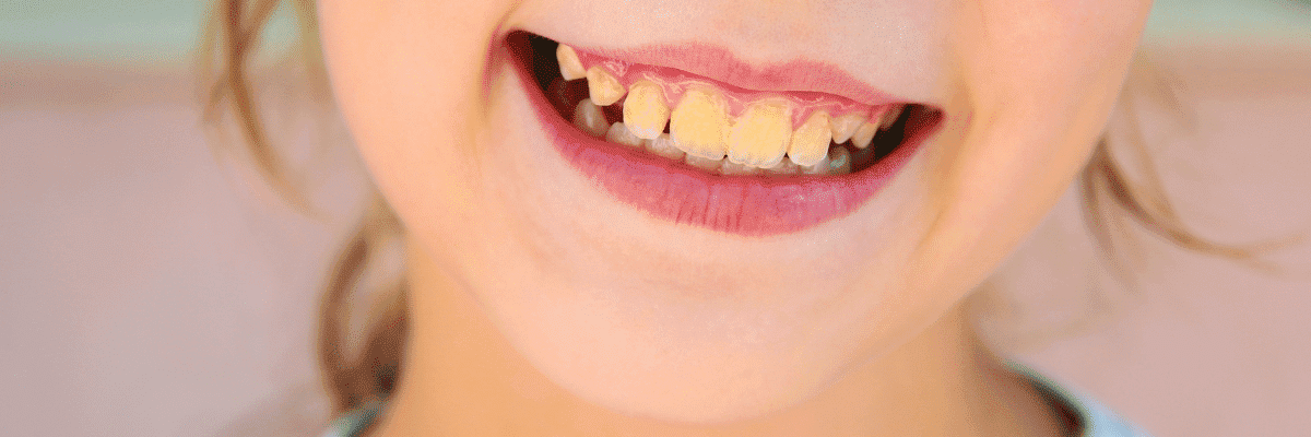 کودکی دختر 5 ساله که دندان هایش زرد شده اند